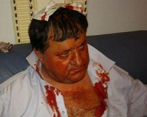 Побитого БЮТівця Петрука прооперували