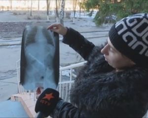 Скандал у Харкові: хірург забув у животі дитини струну