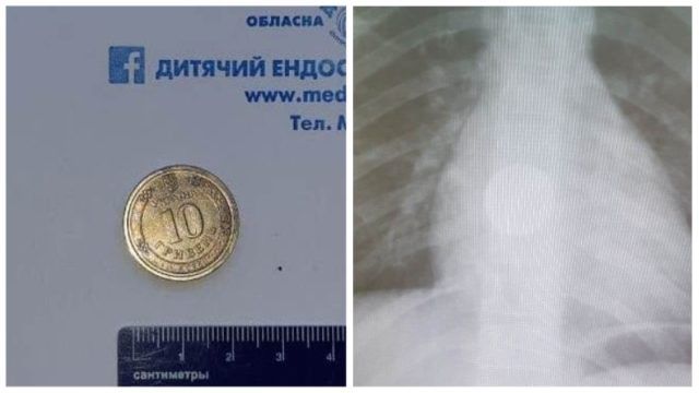 В Днепре 8-летний ребенок проглотил 10-гривневую монету