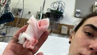 Вайшевські втратила палець