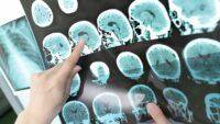 жінки набагато частіше страждають на інсульт