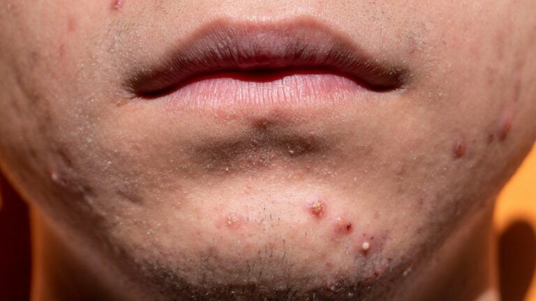 прищі акне лікування