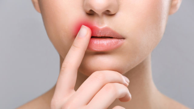 Рецидивирующий герпес: почему возникает и как лечить герпес