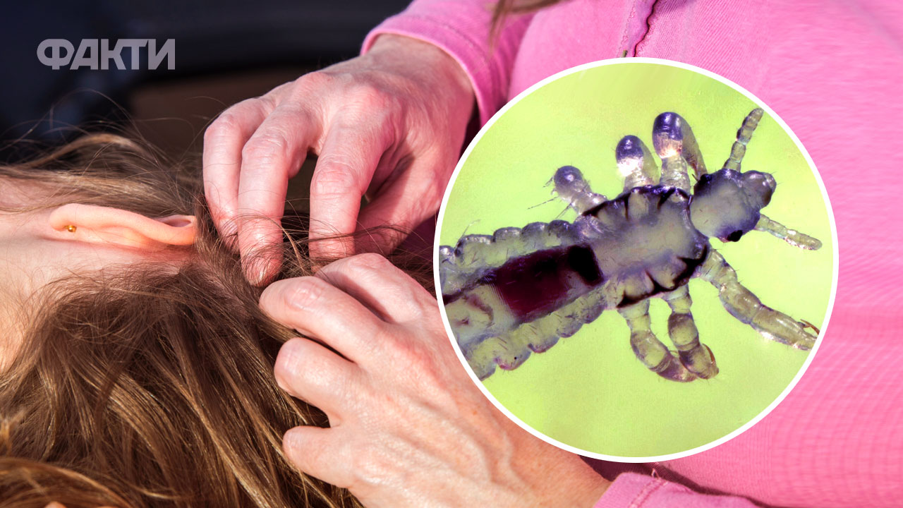 Как можно быстро вывести вши як вивести вошей