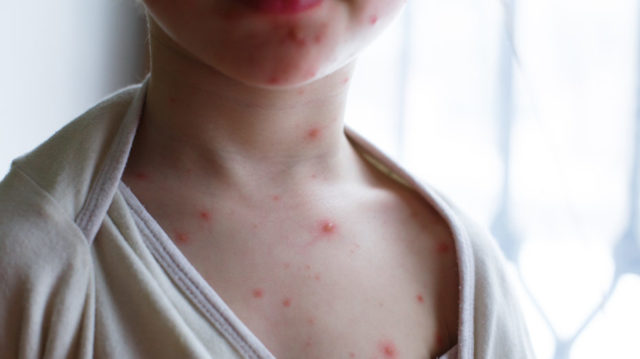 Оспа обезьян: будет ли пандемия и массовая вакцинация віспа