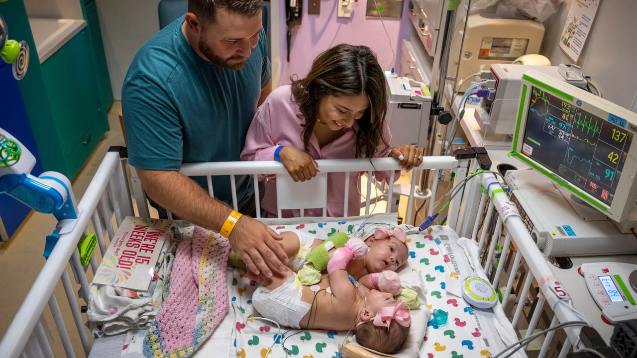 сіамські близнюки