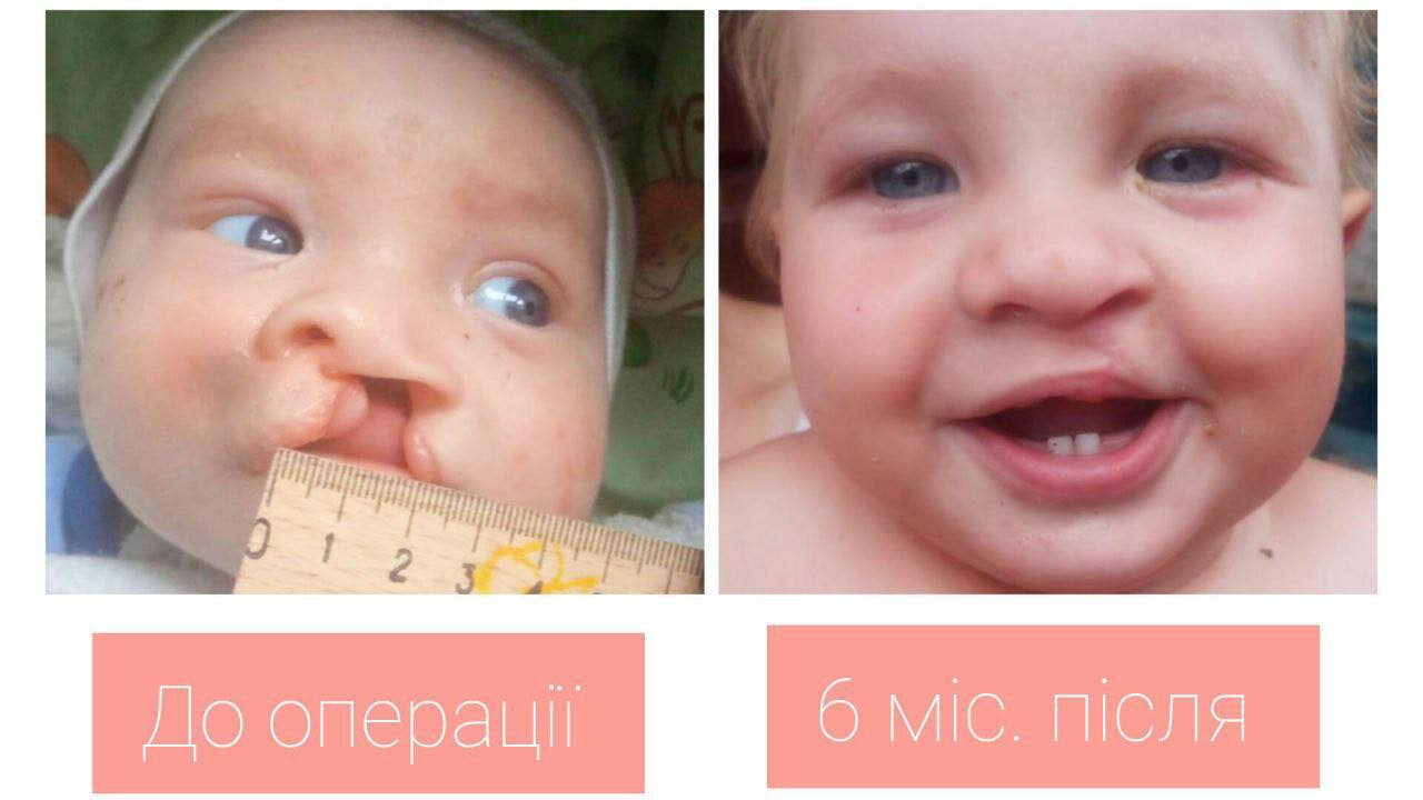 Виправили дефект губи, носа, відновлять і піднебіння: у Львові рятують таких малюків